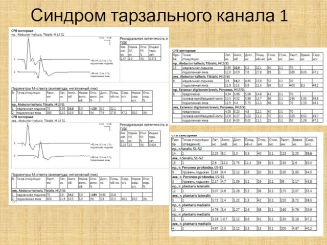 Синдром тарзального канала 1 (4432)