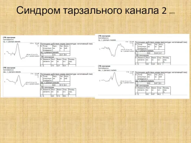 Синдром тарзального канала 2 (4432)