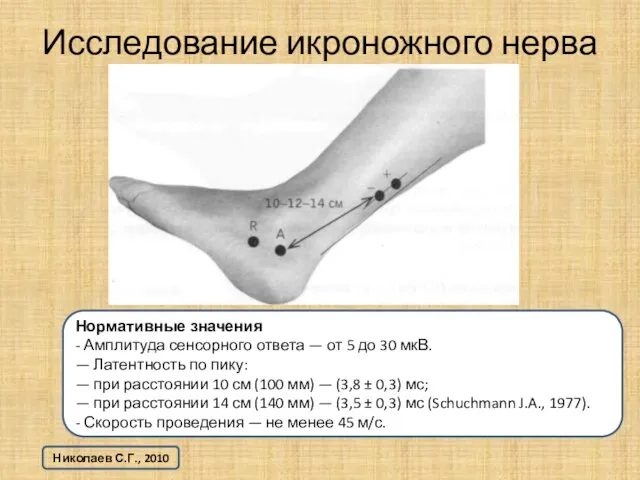 Исследование икроножного нерва Нормативные значения - Амплитуда сенсорного ответа — от