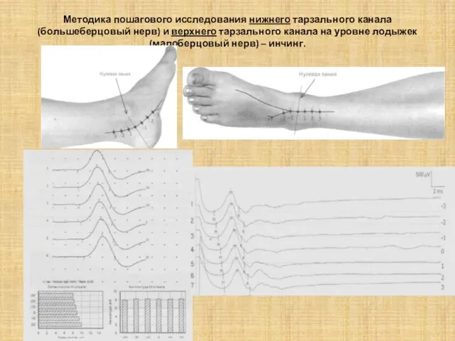 Методика пошагового исследования нижнего тарзального канала (большеберцовый нерв) и верхнего тарзального