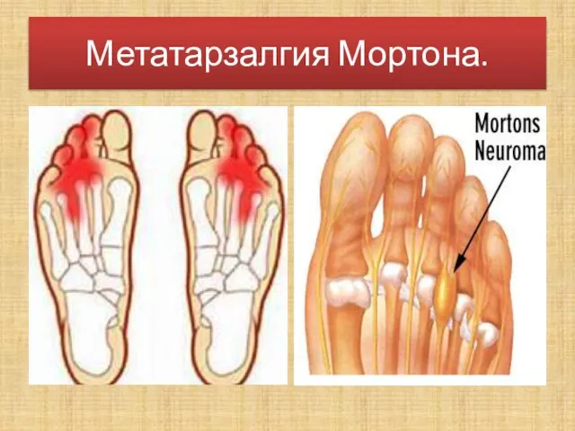 Метатарзалгия Мортона.