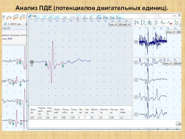 Анализ ПДЕ (потенциалов двигательных единиц).