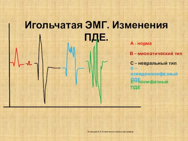 Игольчатая ЭМГ. Изменения ПДЕ. А - норма В – миопатический тип