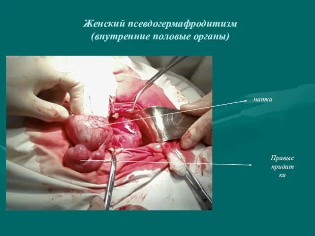 Женский псевдогермафродитизм (внутренние половые органы) матка Правые придатки