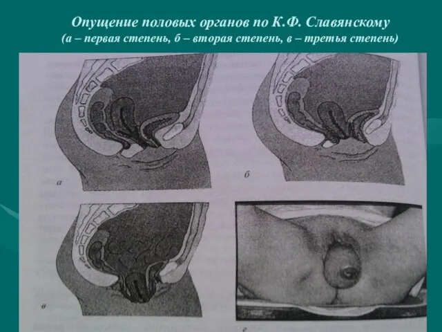 Опущение половых органов по К.Ф. Славянскому (а – первая степень, б