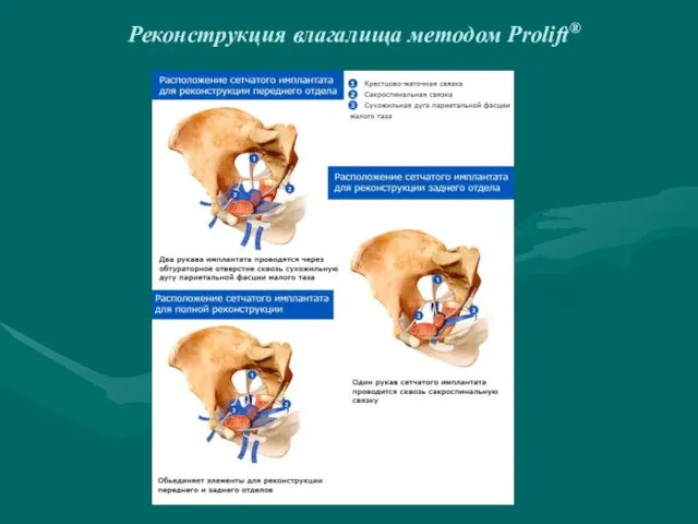 Реконструкция влагалища методом Prolift®