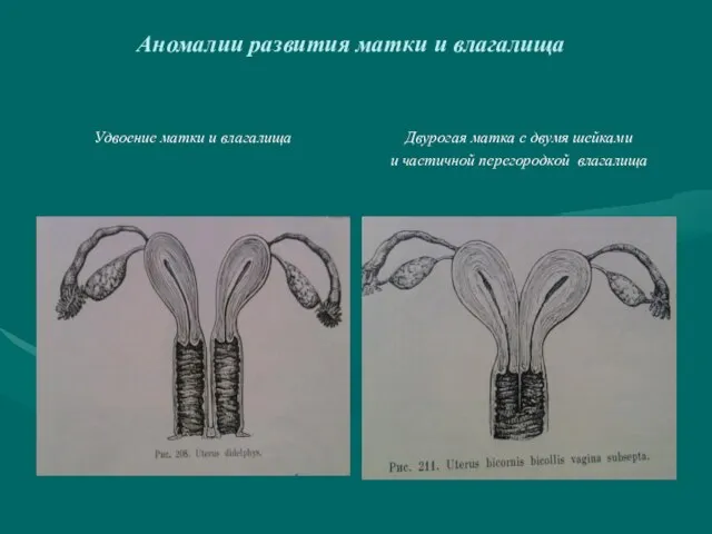 Аномалии развития матки и влагалища Удвоение матки и влагалища Двурогая матка