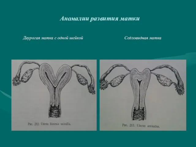Аномалии развития матки Двурогая матка с одной шейкой Седловидная матка