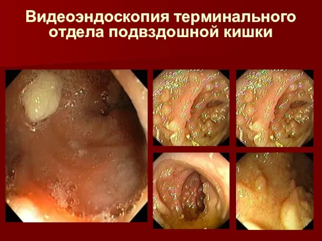 Видеоэндоскопия терминального отдела подвздошной кишки