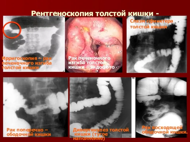 Рентгеноскопия толстой кишки - ирригоскопия Ирригоскопия – рак печеночного изгиба толстой