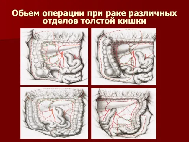 Обьем операции при раке различных отделов толстой кишки