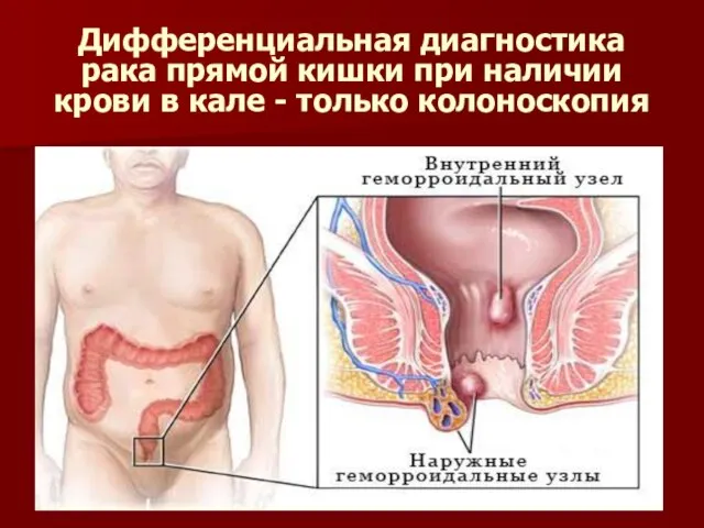 Дифференциальная диагностика рака прямой кишки при наличии крови в кале - только колоноскопия