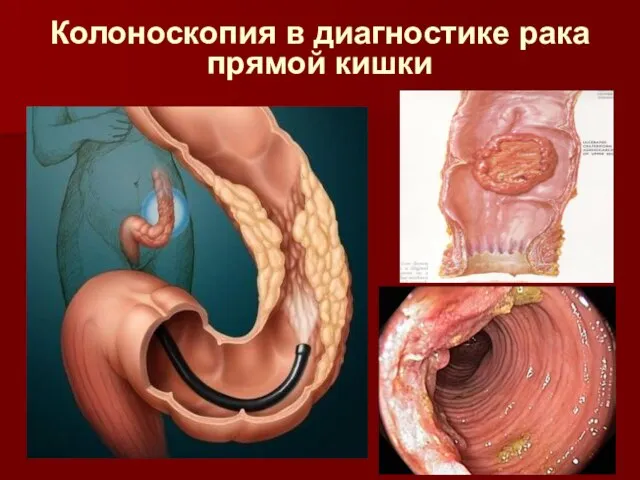 Колоноскопия в диагностике рака прямой кишки