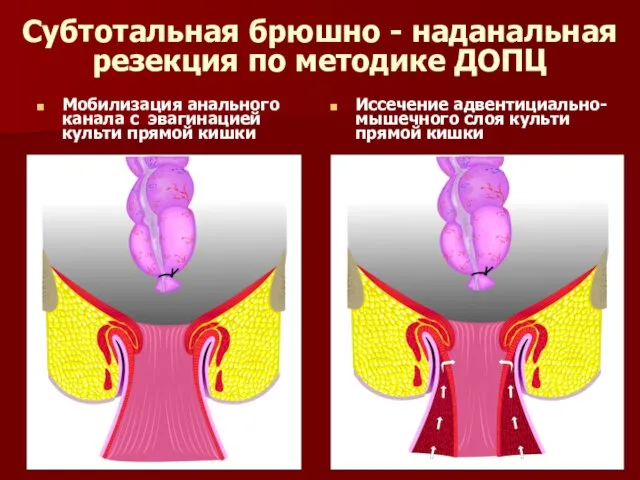 Субтотальная брюшно - наданальная резекция по методике ДОПЦ Мобилизация анального канала