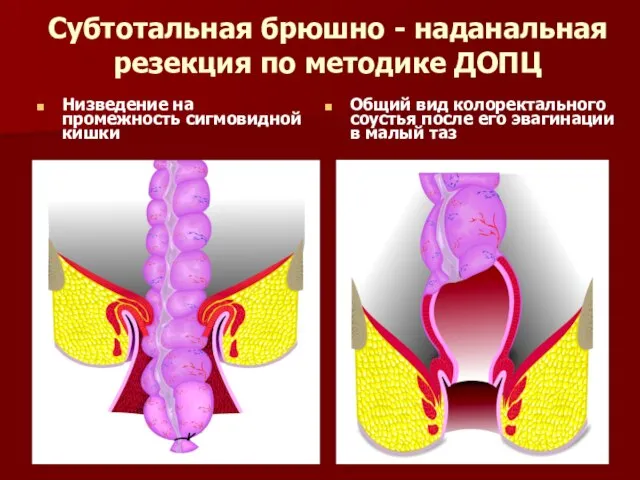 Субтотальная брюшно - наданальная резекция по методике ДОПЦ Низведение на промежность