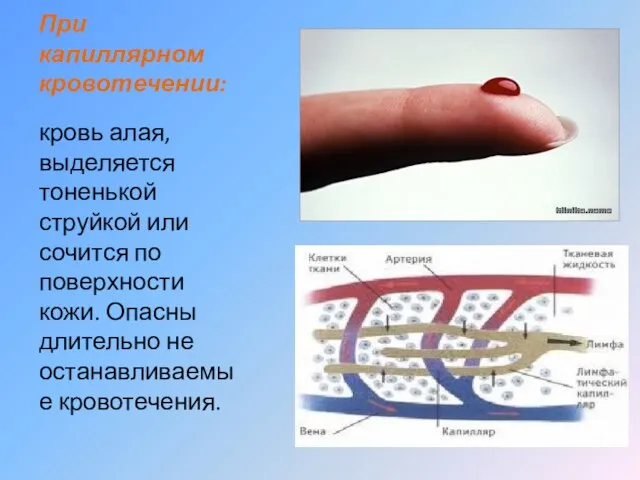 При капиллярном кровотечении: кровь алая, выделяется тоненькой струйкой или сочится по