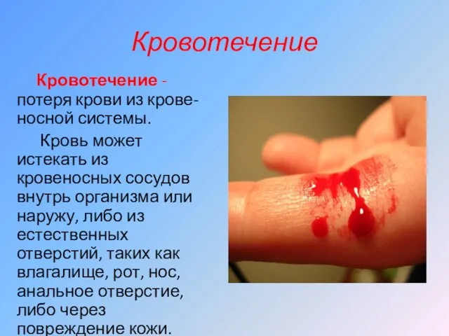 Кровотечение Кровотечение -потеря крови из крове-носной системы. Кровь может истекать из