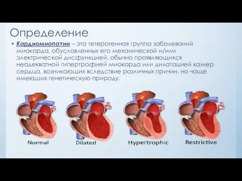 Определение Кардиомиопатии – это гетерогенная группа заболеваний миокарда, обусловленных его механической