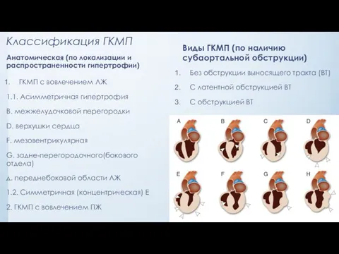 Классификация ГКМП Анатомическая (по локализации и распространенности гипертрофии) ГКМП с вовлечением