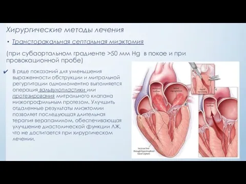 Хирургические методы лечения Трансторакальная септальная миэктомия (при субаортальном градиенте >50 мм