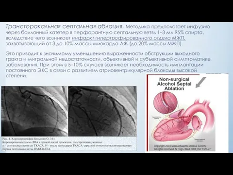 Трансторакальная септальная аблация. Методика предполагает инфузию через баллонный катетер в перфорантную