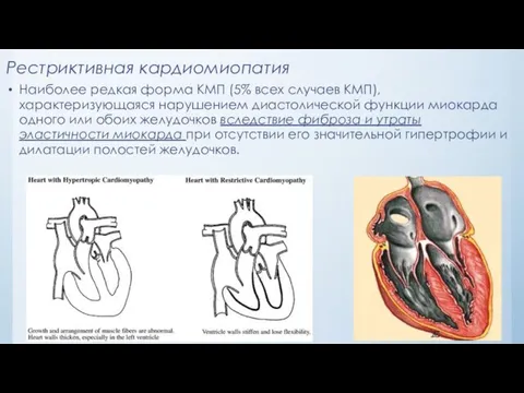 Рестриктивная кардиомиопатия Наиболее редкая форма КМП (5% всех случаев КМП), характеризующаяся