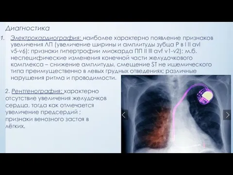 Диагностика Электрокардиография: наиболее характерно появление признаков увеличения ЛП (увеличение ширины и