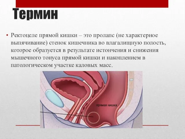 Термин Ректоцеле прямой кишки – это пролапс (не характерное выпячивание) стенок