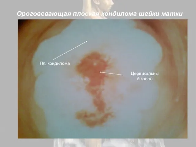 Ороговевающая плоская кондилома шейки матки Пл. кондилома Цервикальный канал