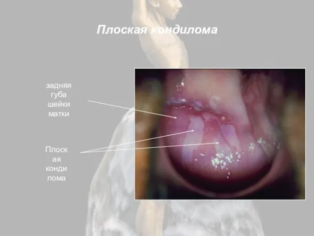 Плоская кондилома задняя губа шейки матки Плоская кондилома