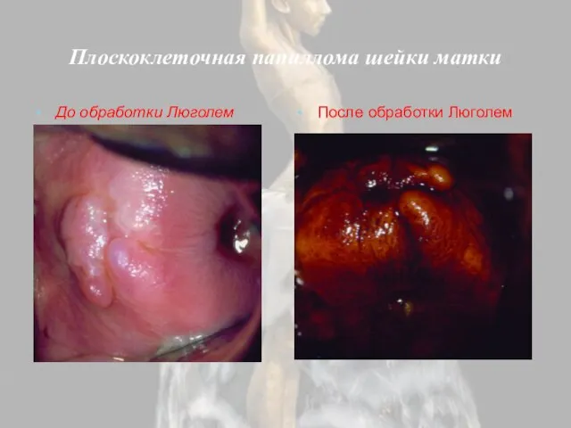 Плоскоклеточная папиллома шейки матки До обработки Люголем После обработки Люголем