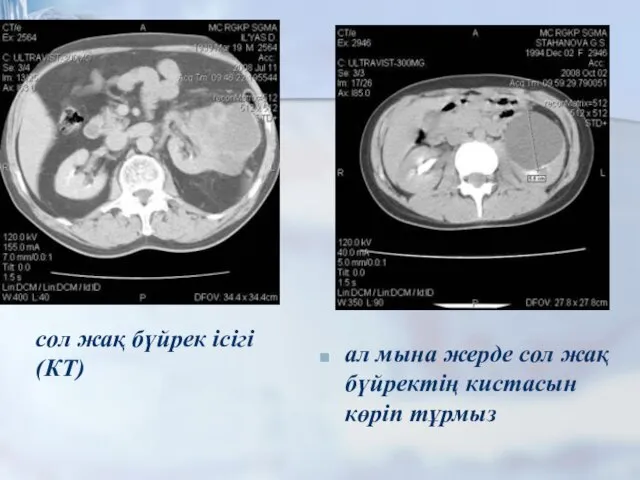 ал мына жерде сол жақ бүйректің кистасын көріп тұрмыз сол жақ бүйрек ісігі (КТ)