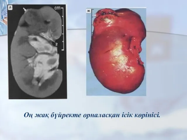 Оң жақ бүйректе орналасқан ісік көрінісі.