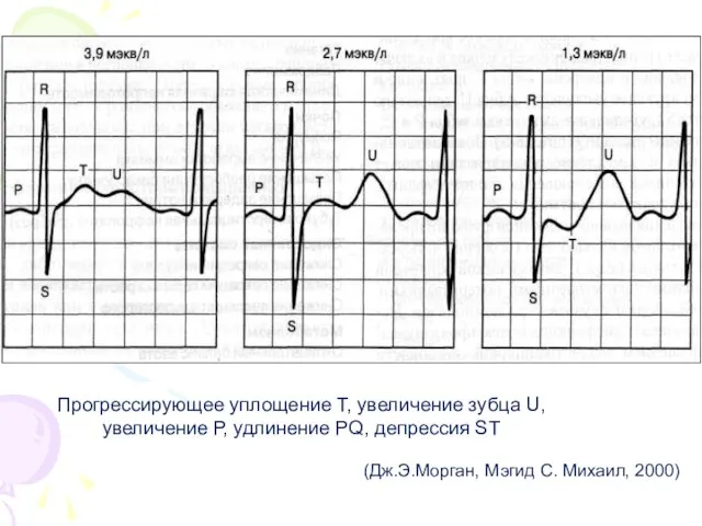 Прогрессирующее уплощение Т, увеличение зубца U, увеличение Р, удлинение РQ, депрессия