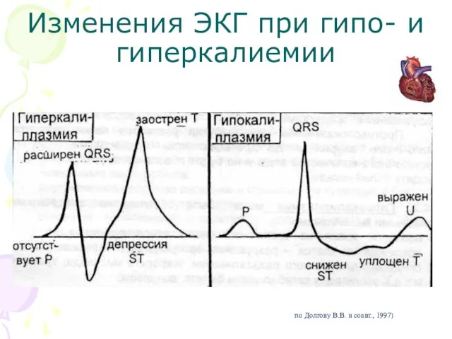 Изменения ЭКГ при гипо- и гиперкалиемии (по Долгову В.В. и соавт., 1997)