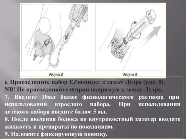 6. Присоедините набор EZ­коннект к замку Луэра (рис. 8). NB! Не