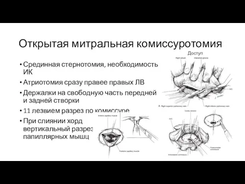 Открытая митральная комиссуротомия Срединная стернотомия, необходимость ИК Атриотомия сразу правее правых