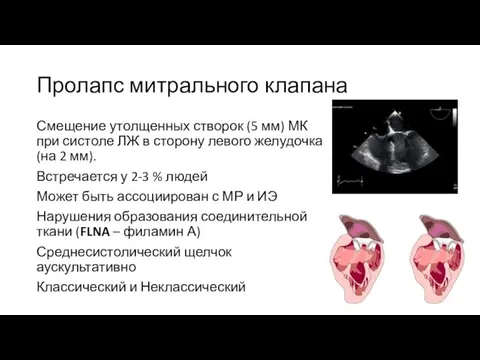 Пролапс митрального клапана Смещение утолщенных створок (5 мм) МК при систоле