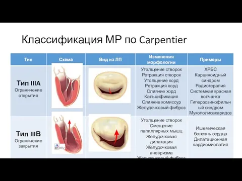 Классификация МР по Carpentier