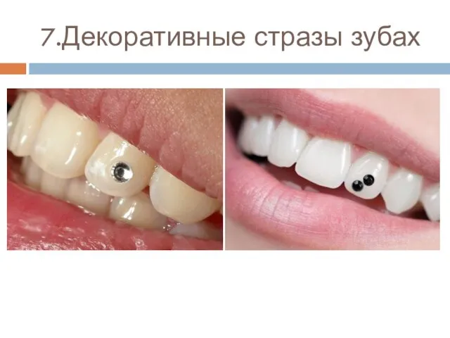 7.Декоративные стразы зубах