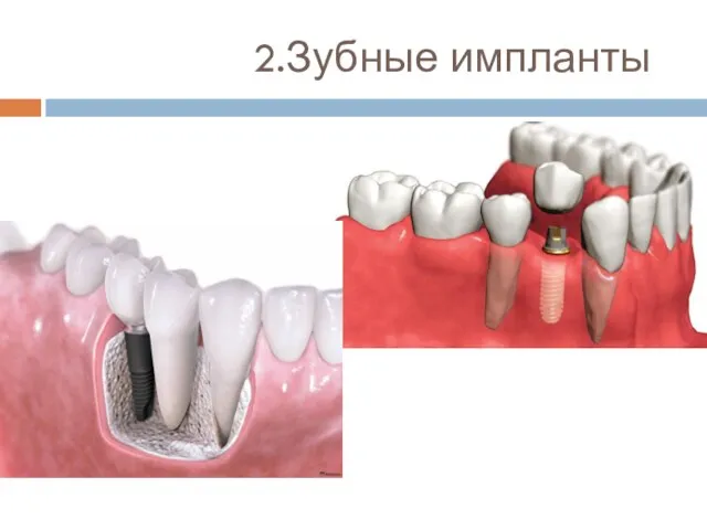 2.Зубные импланты