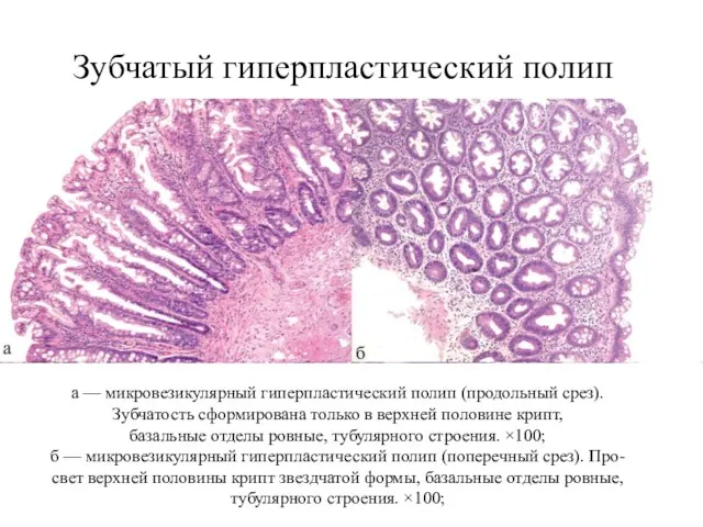 Зубчатый гиперпластический полип а — микровезикулярный гиперпластический полип (продольный срез). Зубчатость