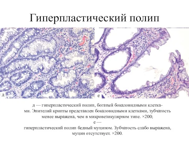 Гиперпластический полип д — гиперпластический полип, богатый бокаловидными клетка- ми. Эпителий