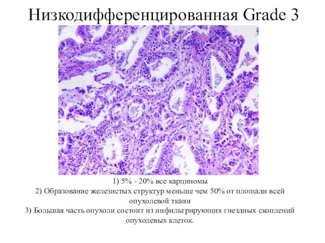 Низкодифференцированная Grade 3 1) 5% - 20% все карциномы 2) Образование