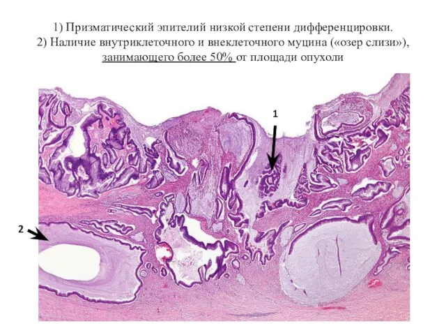 1) Призматический эпителий низкой степени дифференцировки. 2) Наличие внутриклеточного и внеклеточного