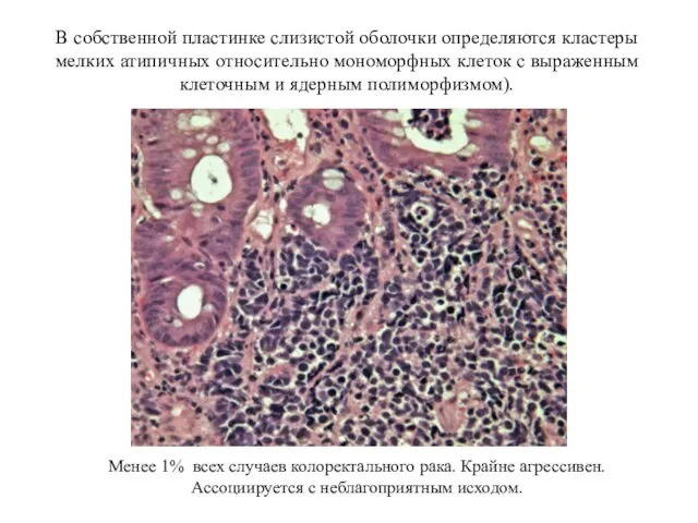 В собственной пластинке слизистой оболочки определяются кластеры мелких атипичных относительно мономорфных