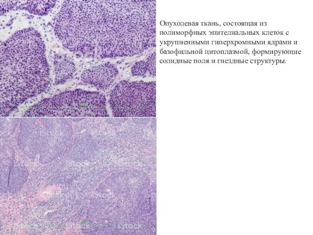 Опухолевая ткань, состоящая из полиморфных эпителиальных клеток с укрупненными гиперхромными ядрами
