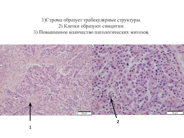 1)Строма образует трабекулярные структуры. 2) Клетки образуют синцитии. 3) Повышенное количество патологических митозов. 2 1