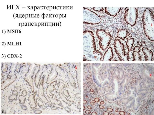 ИГХ – характеристики (ядерные факторы транскрипции) 1 2 3 1) MSH6 2) MLH1 3) CDX-2