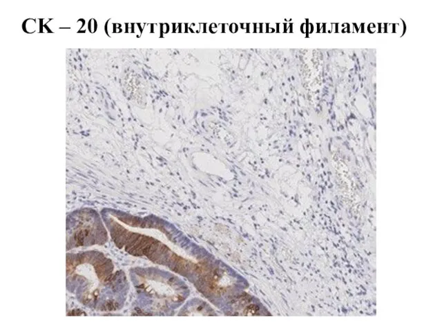 CK – 20 (внутриклеточный филамент)